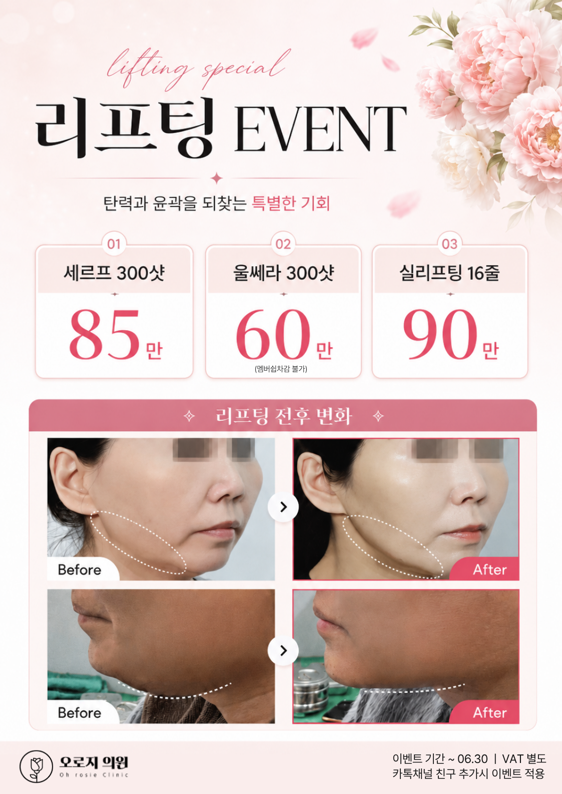 오로지의원 리프팅 이벤트